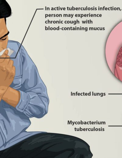 Active tuberculosis cases are currently higher in Harris County than anywhere else in Texas or the US.